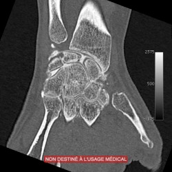 BILAN SCANNER ARTHROSE