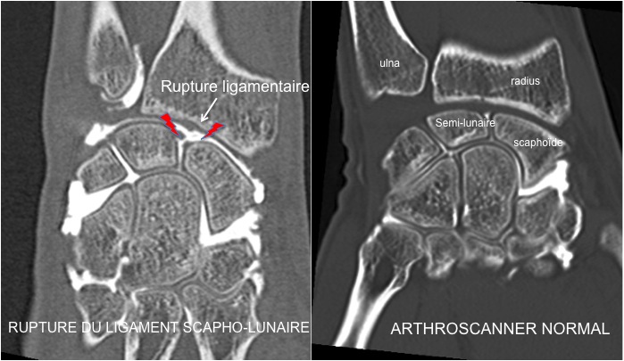 scanner lesion ligamentaire