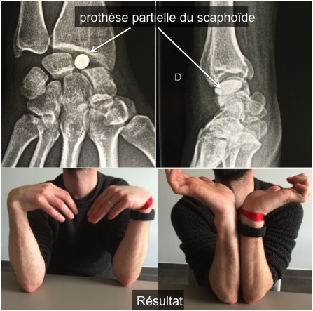 PDF) Traitement de la pseudarthrose du radius par greffe osseuse et plaque  vissée. A propos d'un cas et revue de la littérature